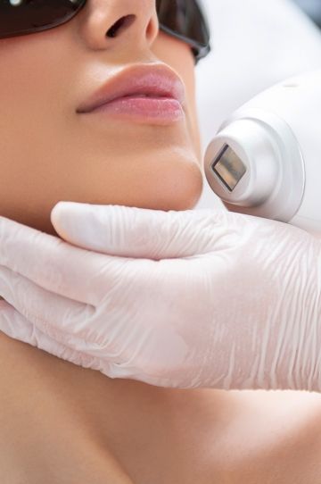Laser hair removal on chin